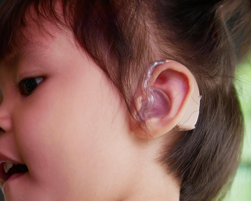 Cochlear Implants